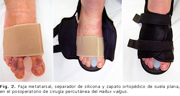 Cirug a percut nea de Hallux valgus moderados y severos mediante